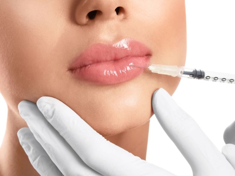 Preenchimento Labial. Saiba Tudo Sobre Preenchimento Labial, Como Funciona, Quanto Tempo Dura, Cuidados e Muito Mais.